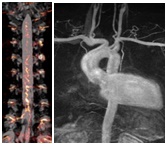 Tricks Angiogram